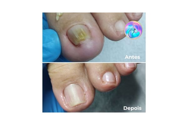 Foto de antes e depois do tratamento 11